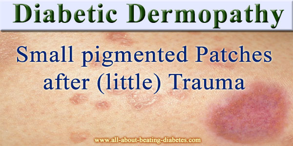 Diabetic dermopathy - a comprehensive review