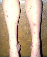 dark spots on legs diabetes #9