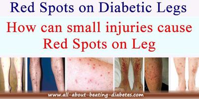 Red spots on Diabetic legs