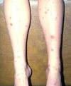 diabetes red spots