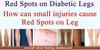 Diabetes legs red Spots