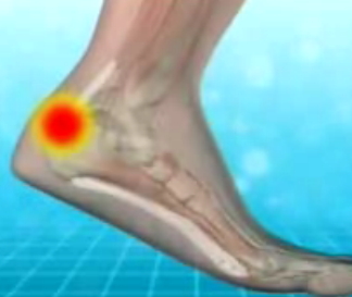 type 2 diabetes and leg hurts