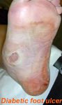 Clinical example of a diabetes-related foot ulcer